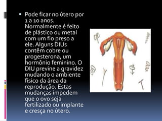  Pode ficar no útero por
  1 a 10 anos.
  Normalmente é feito
  de plástico ou metal
  com um fio preso a
  ele. Alguns DIUs
  contêm cobre ou
  progesterona, um
  hormônio feminino. O
  DIU previne a gravidez
  mudando o ambiente
  físico da área da
  reprodução. Estas
  mudanças impedem
  que o ovo seja
  fertilizado ou implante
  e cresça no útero.
 