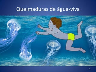 Queimaduras de água-viva
49
 