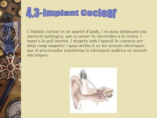 4.3-Implant Coclear L’implant coclear és un aparell d’ajuda, i es posa mitjançant una operació quirúrgica, que es posar-te electrodes a la còclea, i imant a la pell interior, i desprès amb l’aparell fa contacte per mitjà camp magnètic i quan arriba el so les senyals elèctriques que el processador transforma la informació auditiva en senyals elèctriques.  