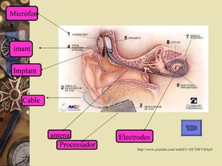 Micròfon Cable imant Electrodes Implant antena Processador http:// www . youtube . com / watch ?v= ECT6FY4cby0 