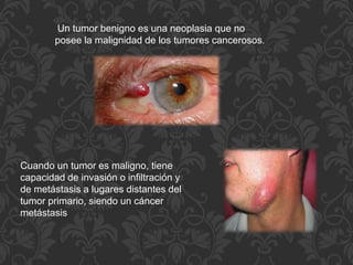 Un tumor benigno es una neoplasia que no
posee la malignidad de los tumores cancerosos.
Cuando un tumor es maligno, tiene
capacidad de invasión o infiltración y
de metástasis a lugares distantes del
tumor primario, siendo un cáncer
metástasis
 