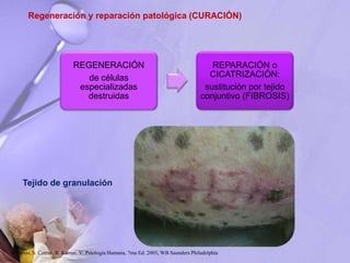 Regeneración y reparación patológica (CURACIÓN)
REGENERACIÓN
de células
especializadas
destruidas
REPARACIÓN o
CICATRIZACIÓN:
sustitución por tejido
conjuntivo (FIBROSIS)
Tejido de granulación
Robbins, S. Cotran, R. Kumar, V. Patología Humana, 7ma Ed. 2005, WB Saunders Philadelphia
 