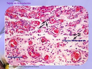 Células inflamatorias
Angiogénesis
Tejido de Granulación
Jesús Boya Vegue Atlas de Histología y Organografía Microscópica
 