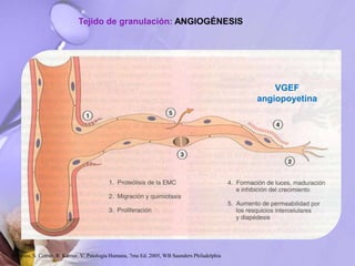 Tejido de granulación: ANGIOGÉNESIS
VGEF
angiopoyetina
Robbins, S. Cotran, R. Kumar, V. Patología Humana, 7ma Ed. 2005, WB Saunders Philadelphia
 