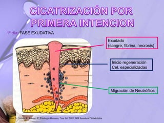 Exudado
(sangre, fibrina, necrosis)
Inicio regeneración
Cel. especializadas
Migración de Neutrófilos
1º día: FASE EXUDATIVA
Hupp, J.R.
Robbins, S. Cotran, R. Kumar, V. Patología Humana, 7ma Ed. 2005, WB Saunders Philadelphia
 