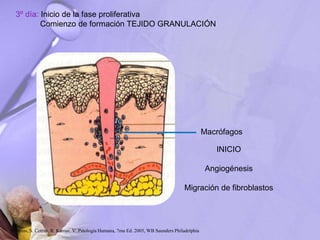 3º día: Inicio de la fase proliferativa
Comienzo de formación TEJIDO GRANULACIÓN
Macrófagos
INICIO
Angiogénesis
Migración de fibroblastos
Robbins, S. Cotran, R. Kumar, V. Patología Humana, 7ma Ed. 2005, WB Saunders Philadelphia
 