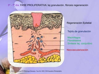 5º - 7º día: FASE PROLIFERATIVA: tej granulación, fibrosis regeneración
Regeneración Epitelial
Tejido de granulación
Macrófagos
Fibroblastos
Síntesis tej. conjuntivo
Neovascularización
Robbins, S. Cotran, R. Kumar, V. Patología Humana, 7ma Ed. 2005, WB Saunders Philadelphia
 