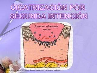 Reacción Inflamatoria
Intensa
Robbins, S. Cotran, R. Kumar, V. Patología Humana, 7ma Ed. 2005, WB Saunders Philadelphia
 