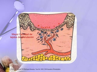 Mayor Cantidad de
tejidos de granulación
Robbins, S. Cotran, R. Kumar, V. Patología Humana, 7ma Ed. 2005, WB Saunders Philadelphia
 