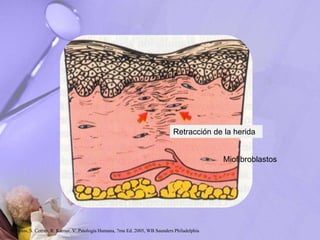 Retracción de la herida
Miofibroblastos
Robbins, S. Cotran, R. Kumar, V. Patología Humana, 7ma Ed. 2005, WB Saunders Philadelphia
 