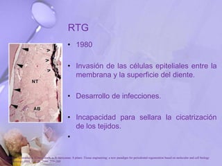 RTG
• 1980
• Invasión de las células epiteliales entre la
membrana y la superficie del diente.
• Desarrollo de infecciones.
• Incapacidad para sellara la cicatrización
de los tejidos.
•
P. Bartold, Christopher a. G.mcculloch, a. S. narayanan. S pitaru .Tissue engineering: a new paradigm for periodontal regeneration based on molecular and cell biology
. Periodontology 2000, Vol. 24, 2000, 253–269
 