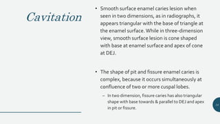 Cavitation
• Smooth surface enamel caries lesion when
seen in two dimensions, as in radiographs, it
appears triangular with the base of triangle at
the enamel surface.While in three-dimension
view, smooth surface lesion is cone shaped
with base at enamel surface and apex of cone
at DEJ.
• The shape of pit and fissure enamel caries is
complex, because it occurs simultaneously at
confluence of two or more cuspal lobes.
– In two dimension, fissure caries has also triangular
shape with base towards & parallel to DEJ and apex
in pit or fissure.
14
 