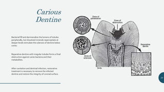 Carious
Dentine
Bacterial fill and demineralize the lumens of tubules
peripherally, but dissolved minerals repercipitate at
deeper levels stimulate the sclerosis of dentine below
caries.
Reparative dentine with irregular tubules forms a final
obstruction against caries bacteria and their
metabolites.
After cavitation and dentinal infection, restorative
treatment is necessary to remove the infected
dentine and restore the integrity of coronal surface.
58
 