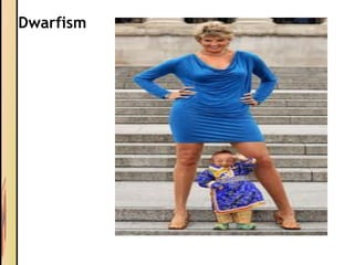 Dwarfism
 