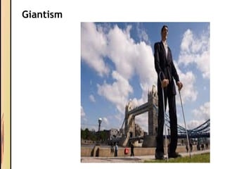 Giantism
 