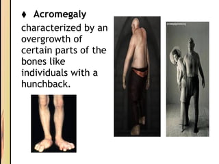 ⬧ Acromegaly
characterized by an
overgrowth of
certain parts of the
bones like
individuals with a
hunchback.
 