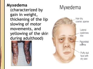 Myxedema
(characterized by
gain in weight,
thickening of the lips
slowing of motor
movements, and
yellowing of the skin
during adulthood)
 