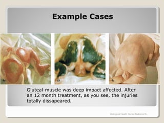 Biological Health Center Mallorca S.L
Gluteal-muscle was deep impact affected. After
an 12 month treatment, as you see, the injuries
totally dissapeared.
Example CasesExample Cases
 