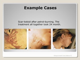 Biological Health Center Mallorca S.L
Scar-keloid after petrol-burning. The
treatment all together took 24 month.
Example CasesExample Cases
 