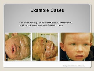 Example CasesExample Cases
Biological Health Center Mallorca S.L
This child was injured by an explosion. He received
a 12 month treatment with fetal skin cells
 