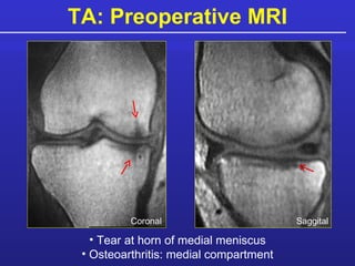 TA: Preoperative MRI Tear at horn of medial meniscus Osteoarthritis: medial compartment Saggital Coronal 