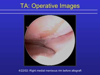 4/22/02: Right medial meniscus rim before allograft TA: Operative Images 