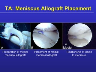 TA: Meniscus Allograft Placement Preparation of medial meniscal allograft Placement of medial meniscal allograft Relationship of lesion to meniscus A B Movie 