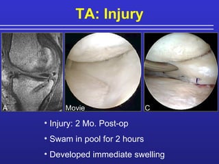 TA: Injury C Injury: 2 Mo. Post-op  Swam in pool for 2 hours  Developed immediate swelling A Movie 