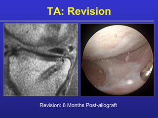TA: Revision C A Movie Revision: 8 Months Post-allograft   