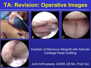 TA: Revision: Operative Images Insertion of Meniscus Allograft with Articular Cartilage Paste Grafting Joint Arthroplasty 3/2006 (38 Mo. Post Op) A B C D 