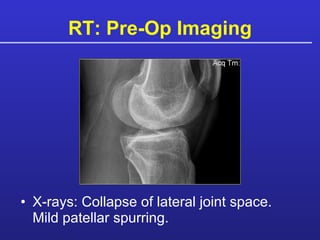 RT: Pre-Op Imaging X-rays: Collapse of lateral joint space. Mild patellar spurring. 