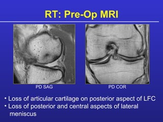RT: Pre-Op MRI Loss of articular cartilage on posterior aspect of LFC Loss of posterior and central aspects of lateral   meniscus PD SAG PD COR 