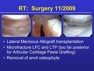 RT:  Surgery 11/2009 Lateral Meniscus Allograft transplantation Microfracture LFC and LTP (too far posterior for Articular Cartilage Paste Grafting) Removal of anvil osteophyte 