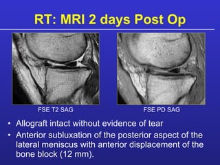RT: MRI 2 days Post Op Allograft intact without evidence of tear Anterior subluxation of the posterior aspect of the lateral meniscus with anterior displacement of the bone block (12 mm). FSE T2 SAG FSE PD SAG 