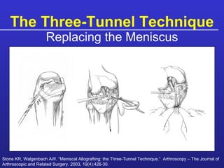 The Three-Tunnel Technique Replacing the Meniscus Stone KR, Walgenbach AW. “Meniscal Allografting: the Three-Tunnel Technique.”  Arthroscopy – The Journal of Arthroscopic and Related Surgery. 2003, 19(4):426-30. 