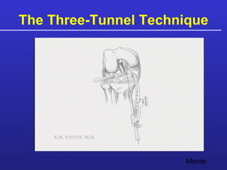 The Three-Tunnel Technique Movie 