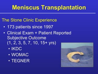 Meniscus Transplantation 173 patients since 1997 Clinical Exam + Patient Reported Subjective Outcome  (1, 2, 3, 5, 7, 10, 15+ yrs) IKDC WOMAC TEGNER The Stone Clinic Experience 