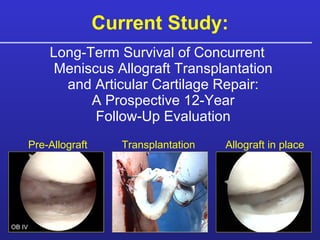 Current Study: Long-Term Survival of Concurrent  Meniscus Allograft Transplantation  and Articular Cartilage Repair:  A Prospective 12-Year  Follow-Up Evaluation  Pre-Allograft Allograft in place Transplantation OB IV 