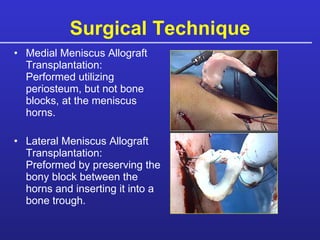 Surgical Technique Medial Meniscus Allograft Transplantation:  Performed utilizing periosteum, but not bone blocks, at the meniscus horns.  Lateral Meniscus Allograft Transplantation:  Preformed by preserving the bony block between the horns and inserting it into a bone trough. 
