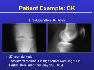 Patient Example: BK 27 year old male Torn lateral meniscus in high school wrestling 1996 Partial lateral meniscectomy 2/96, 8/04 Pre-Operative X-Rays 