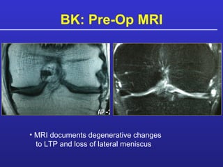 BK: Pre-Op MRI MRI documents degenerative changes   to LTP and loss of lateral meniscus 