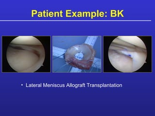 Patient Example: BK Lateral Meniscus Allograft Transplantation 