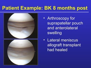Patient Example: BK 8 months post  Arthroscopy for suprapatellar pouch and anterolateral swelling Lateral meniscus allograft transplant had healed 