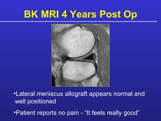 BK MRI 4 Years Post Op Lateral meniscus allograft appears normal and   well positioned Patient reports no pain - “It feels really good” 