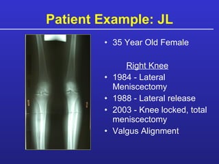 Patient Example: JL 35 Year Old Female Right Knee   1984 - Lateral Meniscectomy 1988 - Lateral release 2003 - Knee locked, total meniscectomy Valgus Alignment  