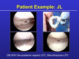 Patient Example: JL OB III/IV far-posterior aspect LFC, Microfracture LFC 