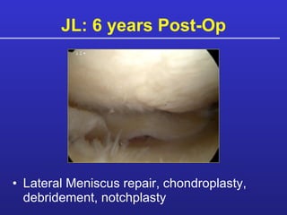 JL: 6 years Post-Op Lateral Meniscus repair, chondroplasty, debridement, notchplasty 