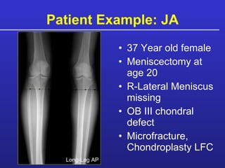 Patient Example: JA 37 Year old female Meniscectomy at age 20 R-Lateral Meniscus missing OB III chondral defect Microfracture, Chondroplasty LFC Long-Leg AP 