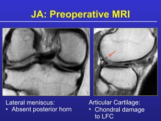 JA: Preoperative MRI Lateral meniscus: Absent posterior horn Articular Cartilage: Chondral damage to LFC 