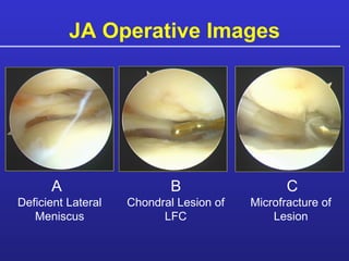 JA Operative Images A B C Deficient Lateral Meniscus Chondral Lesion of LFC Microfracture of Lesion 